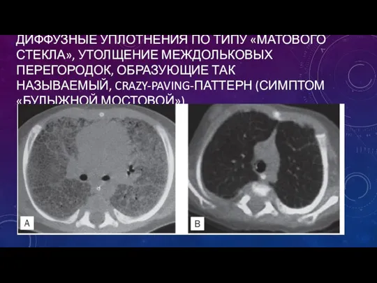 ДИФФУЗНЫЕ УПЛОТНЕНИЯ ПО ТИПУ «МАТОВОГО СТЕКЛА», УТОЛЩЕНИЕ МЕЖДОЛЬКОВЫХ ПЕРЕГОРОДОК, ОБРАЗУЮЩИЕ ТАК НАЗЫВАЕМЫЙ, CRAZY-PAVING-ПАТТЕРН (СИМПТОМ «БУЛЫЖНОЙ МОСТОВОЙ»)