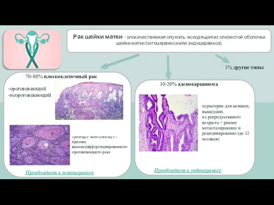 Рак шейки матки - злокачественная опухоль, исходящая из слизистой оболочки шейки