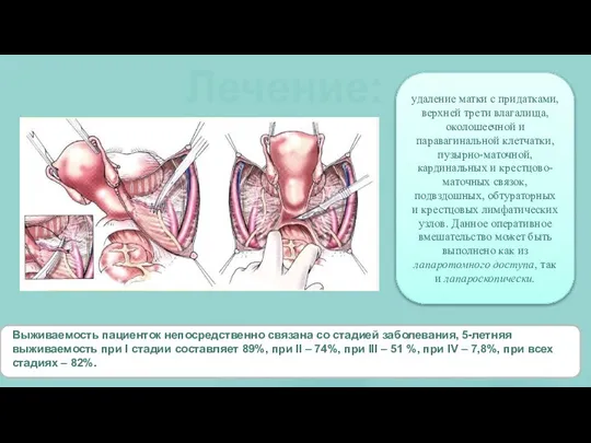 Лечение: Выживаемость пациенток непосредственно связана со стадией заболевания, 5-летняя выживаемость при