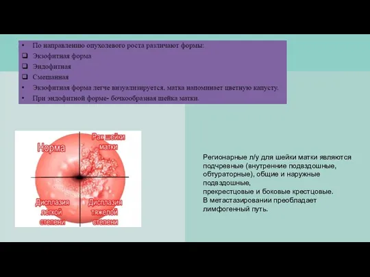 Регионарные л/у для шейки матки являются подчревные (внутренние подвздошные, обтураторные), общие