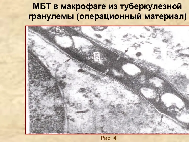 МБТ в макрофаге из туберкулезной гранулемы (операционный материал) Рис. 4