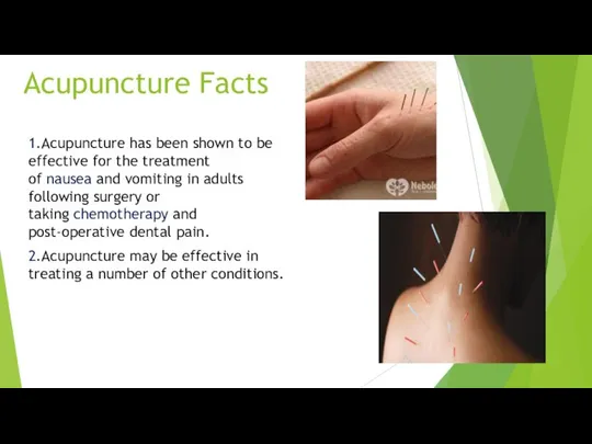 Acupuncture Facts 1.Acupuncture has been shown to be effective for the