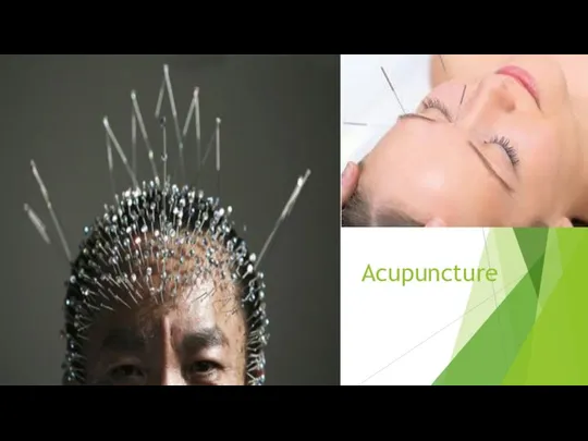 Acupuncture