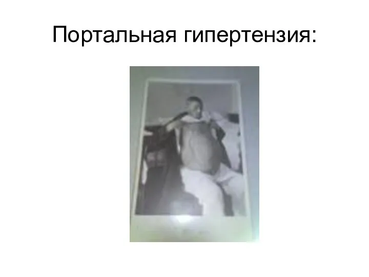 Портальная гипертензия: