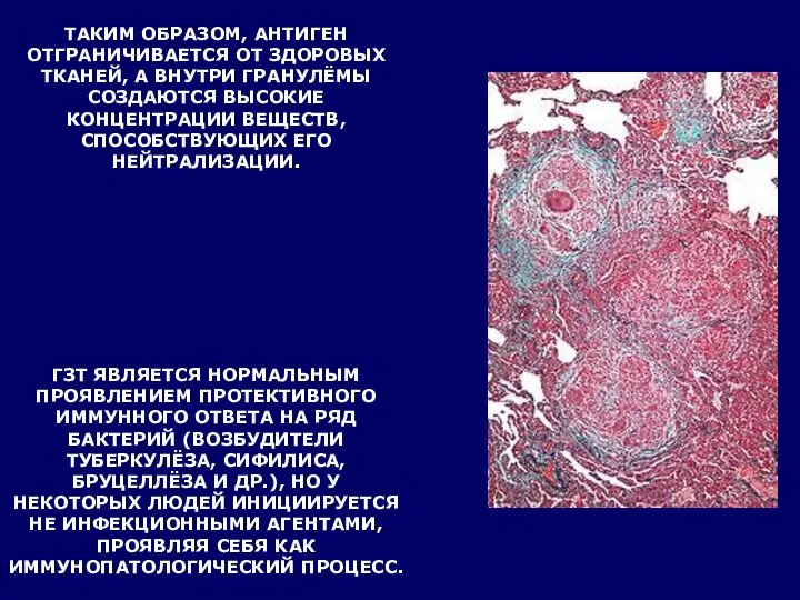 ТАКИМ ОБРАЗОМ, АНТИГЕН ОТГРАНИЧИВАЕТСЯ ОТ ЗДОРОВЫХ ТКАНЕЙ, А ВНУТРИ ГРАНУЛЁМЫ СОЗДАЮТСЯ