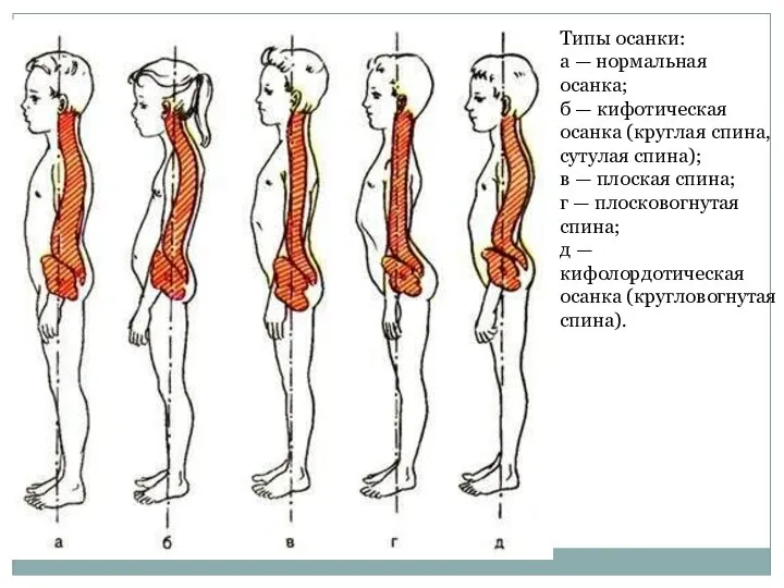 Типы осанки: а — нормальная осанка; б — кифотическая осанка (круглая