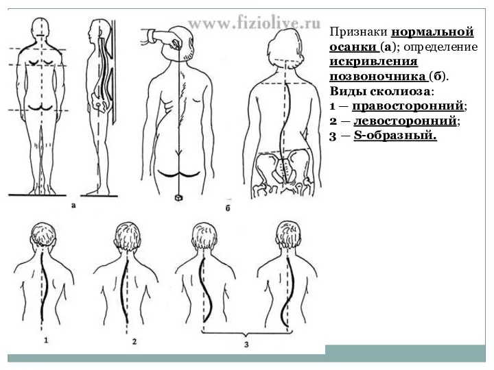 Признаки нормальной осанки (а); определение искривления позвоночника (б). Виды сколиоза: 1