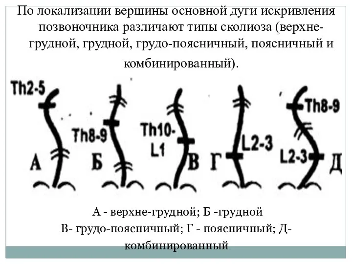 По локализации вершины основной дуги искривления позвоночника различают типы сколиоза (верхне-грудной,