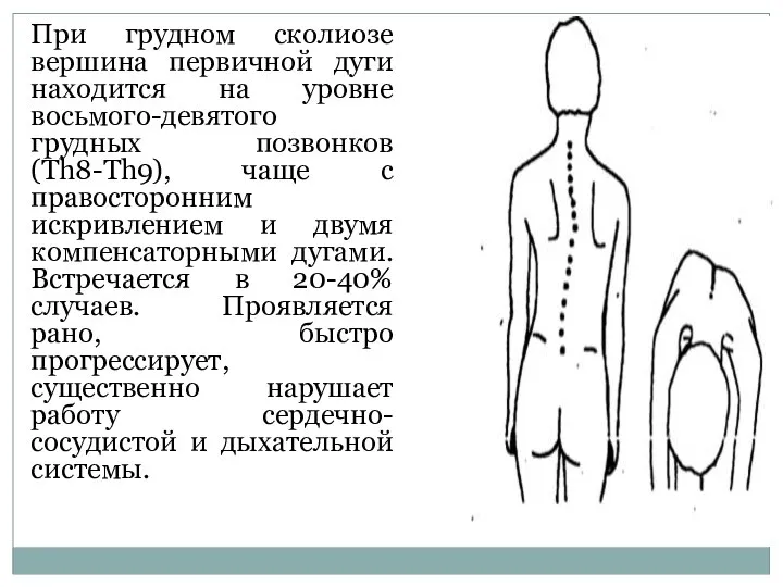 При грудном сколиозе вершина первичной дуги находится на уровне восьмого-девятого грудных