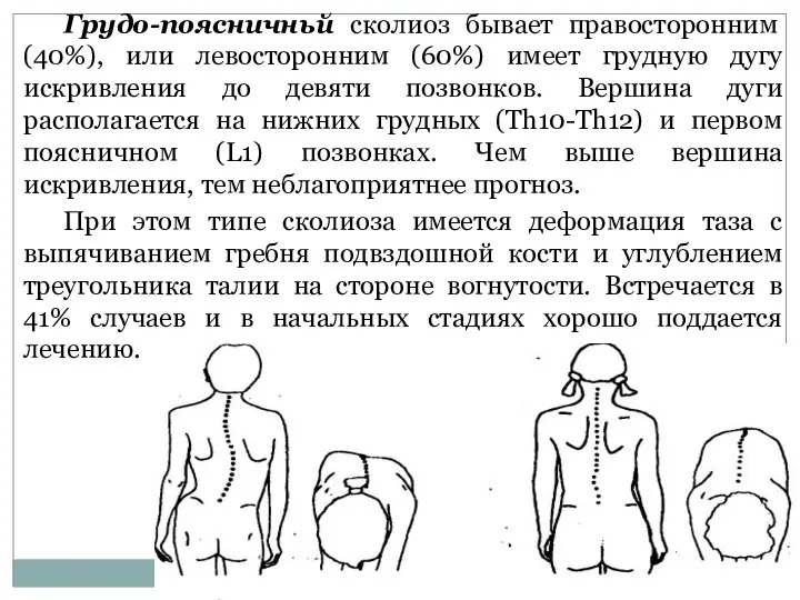 Грудо-поясничньй сколиоз бывает правосторонним (40%), или левосторонним (60%) имеет грудную дугу