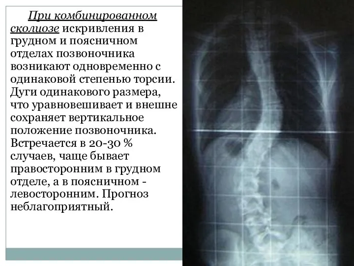 При комбинированном сколиозе искривления в грудном и поясничном отделах позвоночника возникают