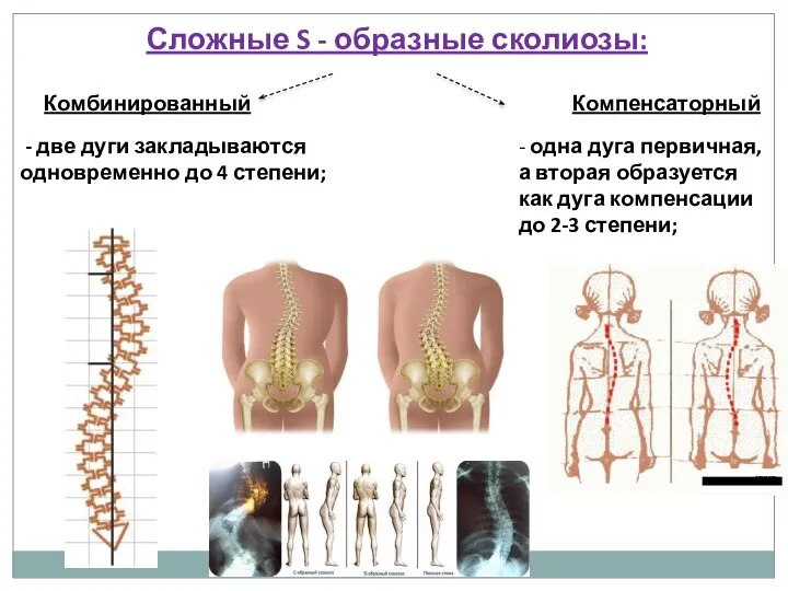 Сложные S - образные сколиозы: - две дуги закладываются одновременно до