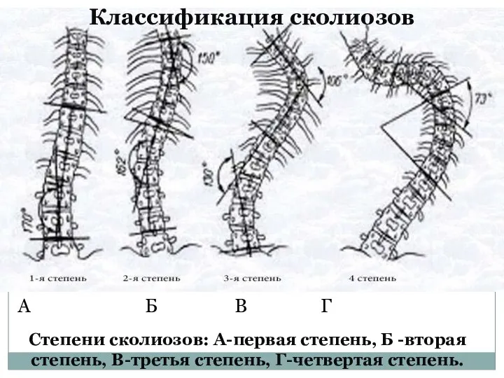 Степени сколиозов: А-первая степень, Б -вторая степень, В-третья степень, Г-четвертая степень.