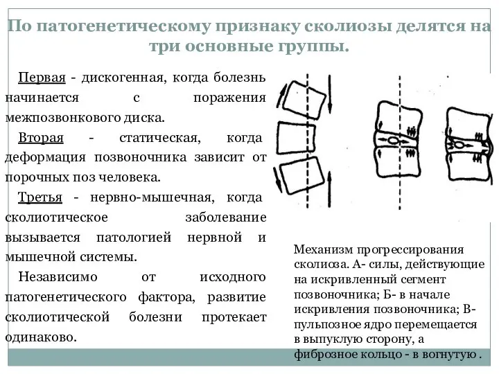 По патогенетическому признаку сколиозы делятся на три основные группы. Первая -