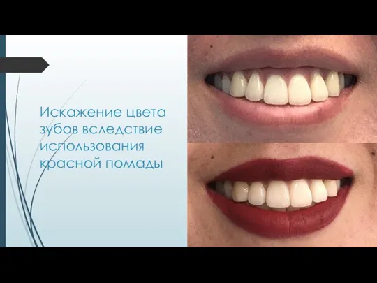 Искажение цвета зубов вследствие использования красной помады