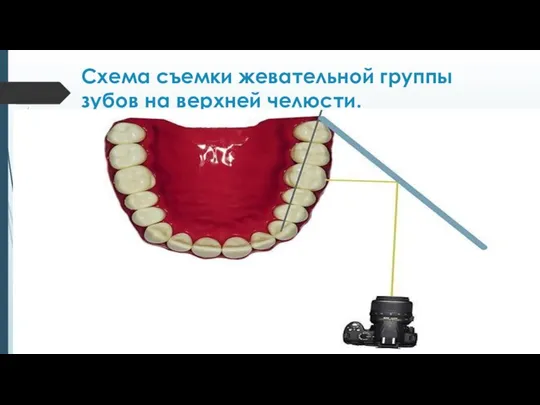 Схема съемки жевательной группы зубов на верхней челюсти.