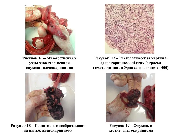 Рисунок 16 – Множественные узлы злокачественной опухоли: аденокарцинома Рисунок 17 –