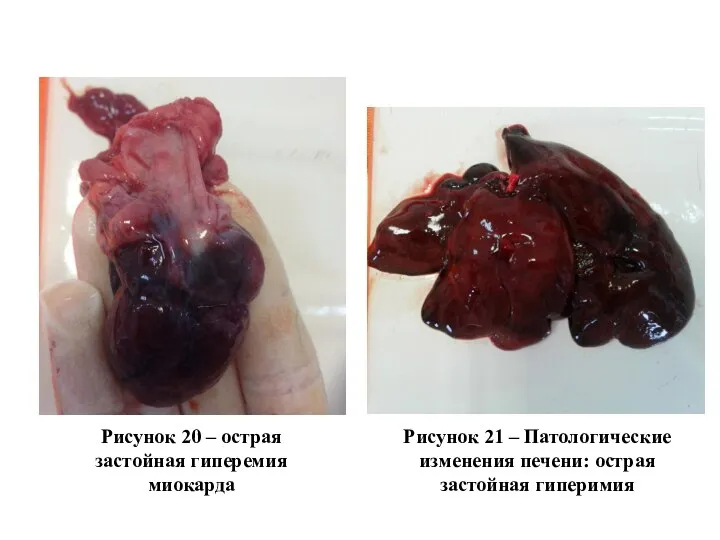 Рисунок 20 – острая застойная гиперемия миокарда Рисунок 21 – Патологические изменения печени: острая застойная гиперимия