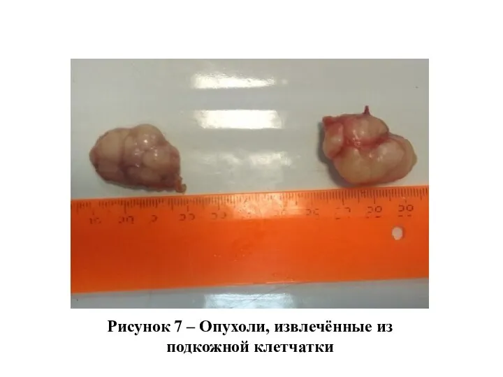 Рисунок 7 – Опухоли, извлечённые из подкожной клетчатки