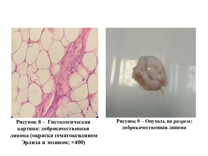 Рисунок 8 – Гистологическая картина: доброкачественная липома (окраска гематоксилином Эрлиха и