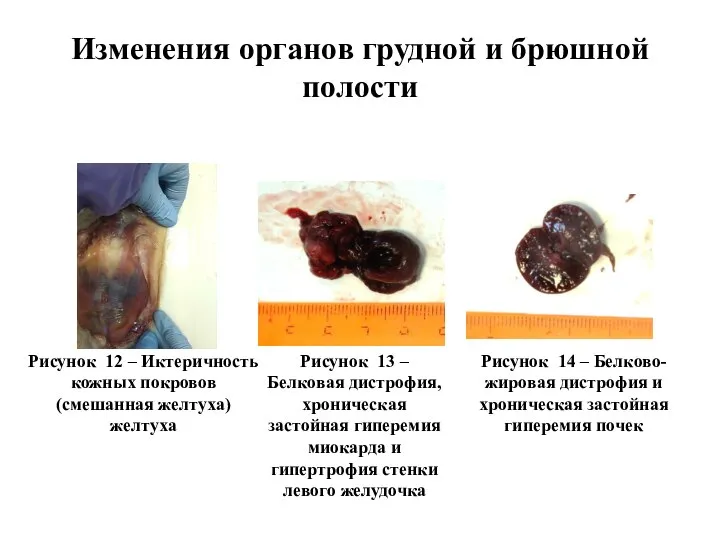 Изменения органов грудной и брюшной полости Рисунок 14 – Белково-жировая дистрофия