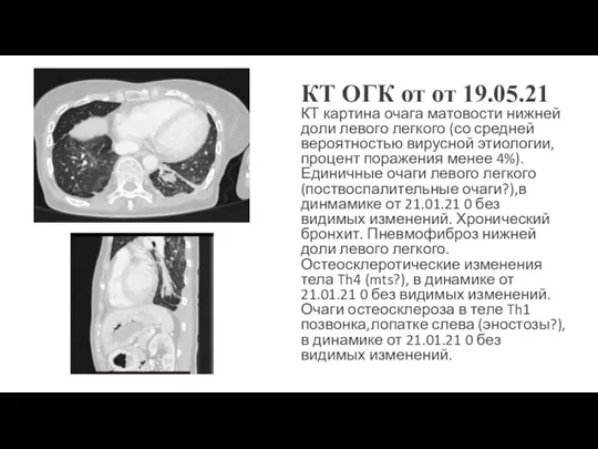 КТ ОГК от от 19.05.21 КТ картина очага матовости нижней доли