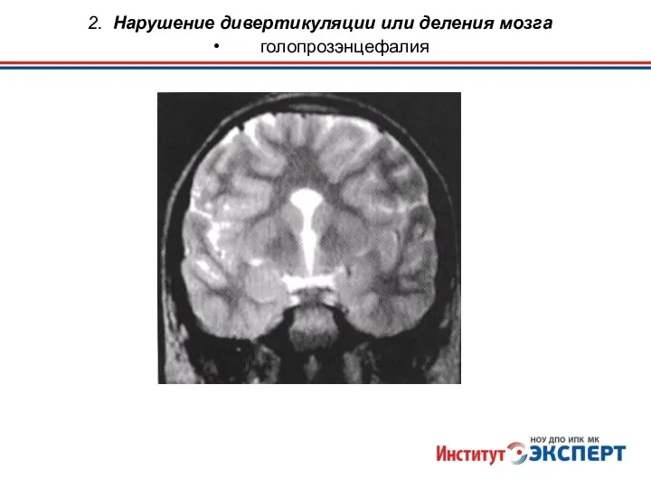 2. Нарушение дивертикуляции или деления мозга голопрозэнцефалия