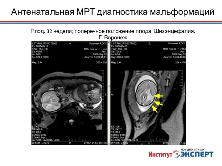 Антенатальная МРТ диагностика мальформаций Плод, 32 недели; поперечное положение плода. Шизэнцефалия. Г. Воронеж