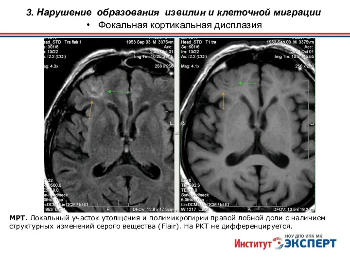 МРТ. Локальный участок утолщения и полимикрогирии правой лобной доли с наличием