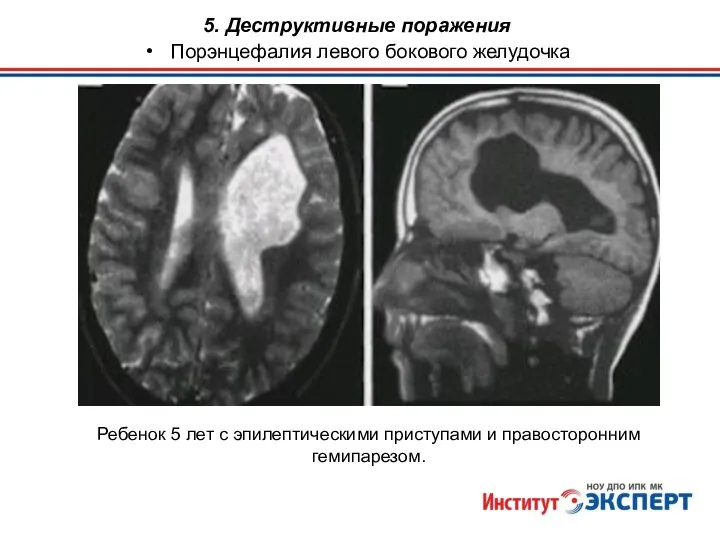 Ребенок 5 лет с эпилептическими приступами и правосторонним гемипарезом. 5. Деструктивные поражения Порэнцефалия левого бокового желудочка