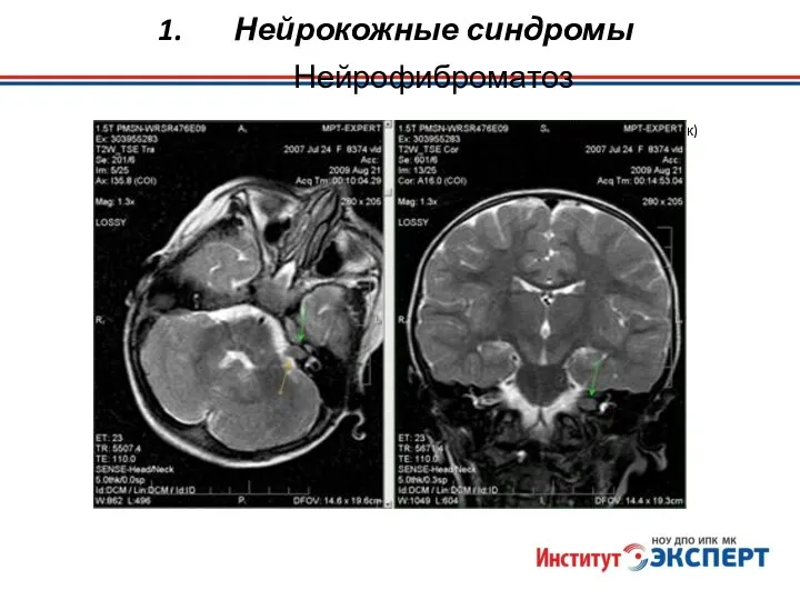 Нейрокожные синдромы Нейрофиброматоз невринома VIII п. ч.м.н. слева малых размеров (до 1,0 см). (г. Владивосток)