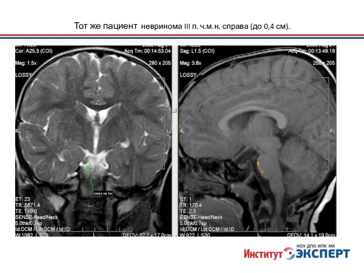 Тот же пациент невринома III п. ч.м.н. справа (до 0,4 см).
