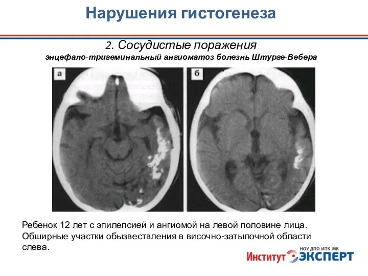 Нарушения гистогенеза 2. Сосудистые поражения энцефало-тригеминальный ангиоматоз болезнь Штурге-Вебера Ребенок 12