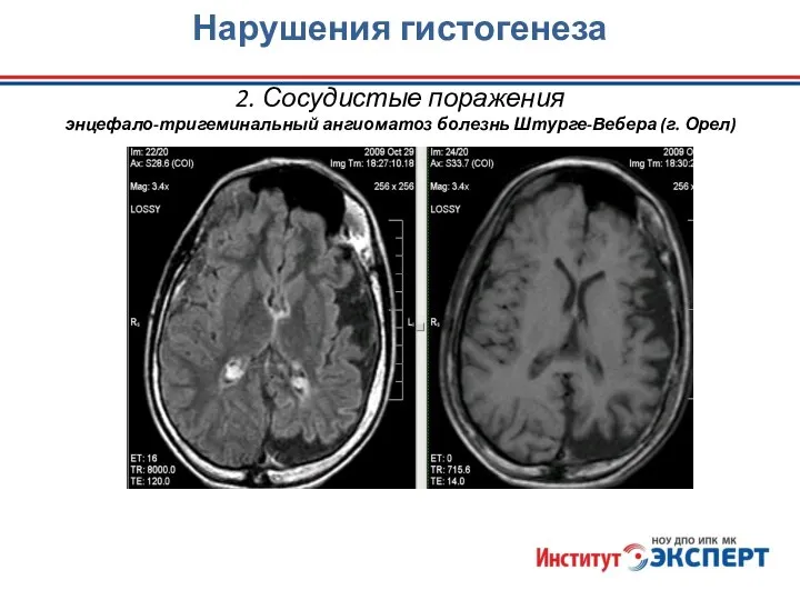 Нарушения гистогенеза 2. Сосудистые поражения энцефало-тригеминальный ангиоматоз болезнь Штурге-Вебера (г. Орел)