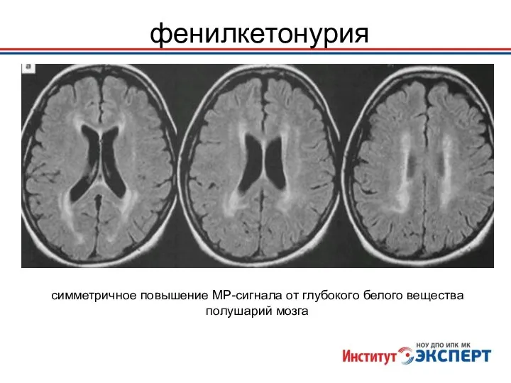 фенилкетонурия симметричное повышение МР-сигнала от глубокого белого вещества полушарий мозга