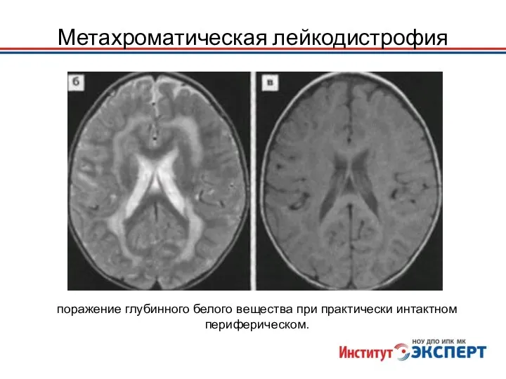 Метахроматическая лейкодистрофия поражение глубинного белого вещества при практически интактном периферическом.