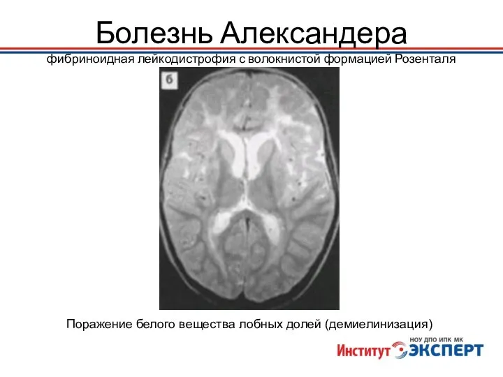 Болезнь Александера фибриноидная лейкодистрофия с волокнистой формацией Розенталя Поражение белого вещества лобных долей (демиелинизация)