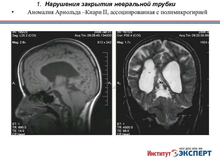 1. Нарушения закрытия невральной трубки Аномалия Арнольда –Киари II, ассоциированная с полимикрогирией