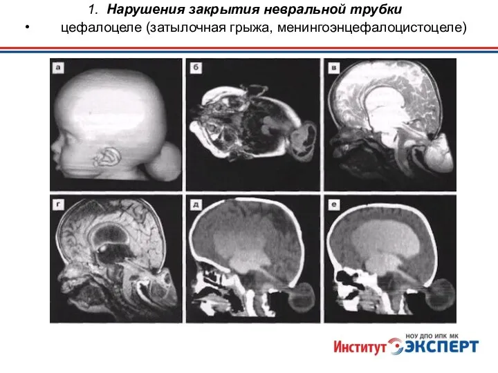 1. Нарушения закрытия невральной трубки цефалоцеле (затылочная грыжа, менингоэнцефалоцистоцеле)