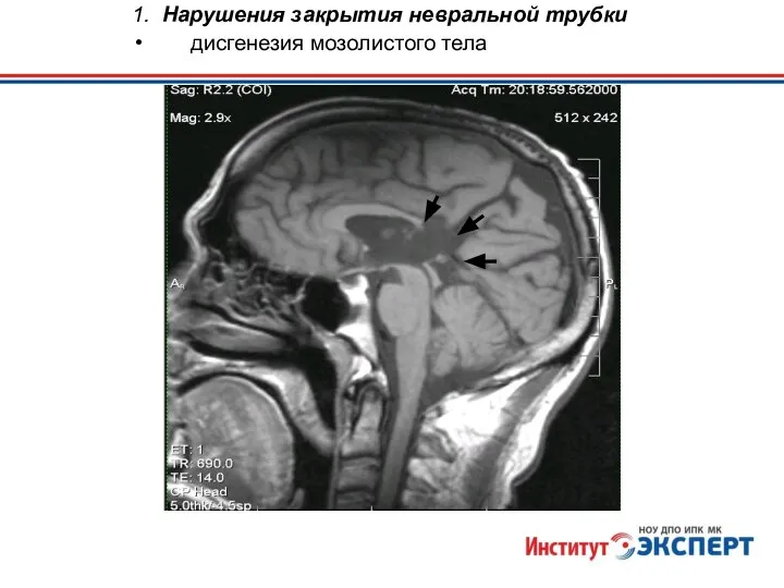 1. Нарушения закрытия невральной трубки дисгенезия мозолистого тела