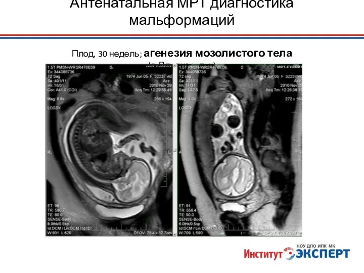 Антенатальная МРТ диагностика мальформаций Плод, 30 недель; агенезия мозолистого тела (г. Владивосток)