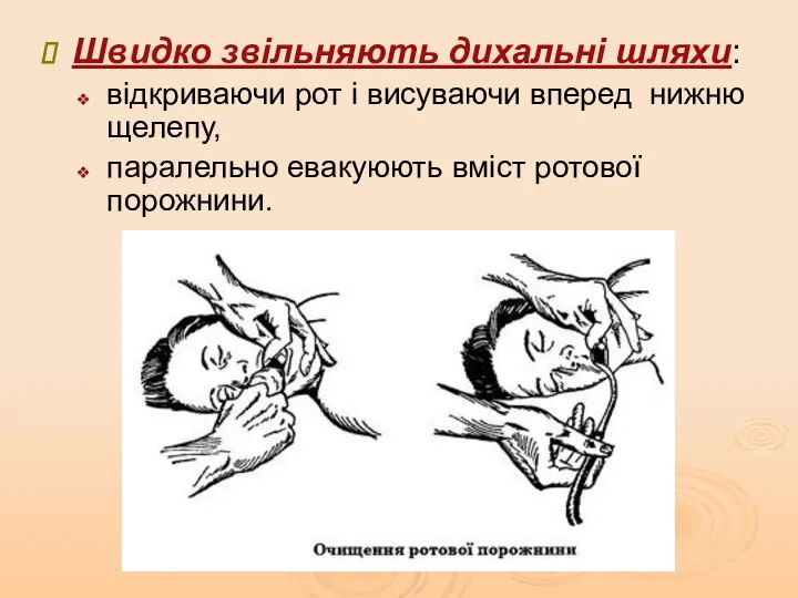 Швидко звільняють дихальні шляхи: відкриваючи рот і висуваючи вперед нижню щелепу, паралельно евакуюють вміст ротової порожнини.