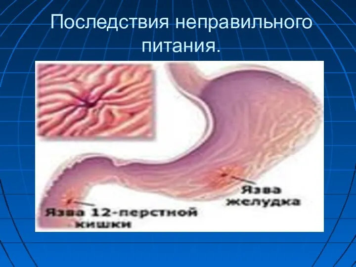 Последствия неправильного питания.