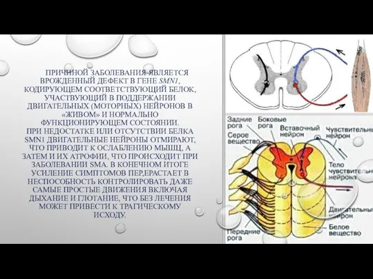 ПРИЧИНОЙ ЗАБОЛЕВАНИЯ ЯВЛЯЕТСЯ ВРОЖДЕННЫЙ ДЕФЕКТ В ГЕНЕ SMN1, КОДИРУЮЩЕМ СООТВЕТСТВУЮЩИЙ БЕЛОК,