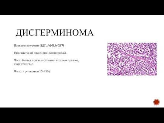 ДИСГЕРМИНОМА Повышение уровня ЛДГ, АФП, b-ХГЧ Развивается из дисгенетической гонады. Часто