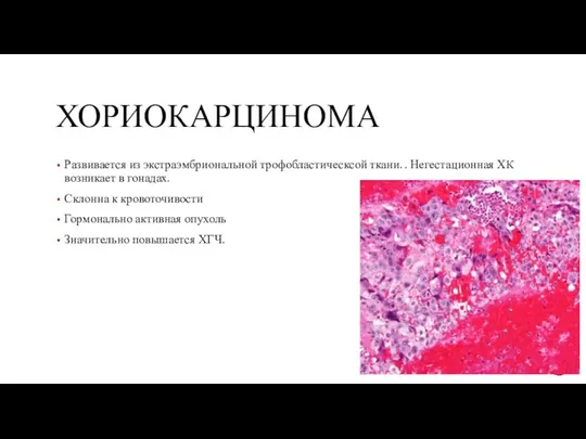 ХОРИОКАРЦИНОМА Развивается из экстраэмбриональной трофобластическсой ткани. . Негестационная ХК возникает в