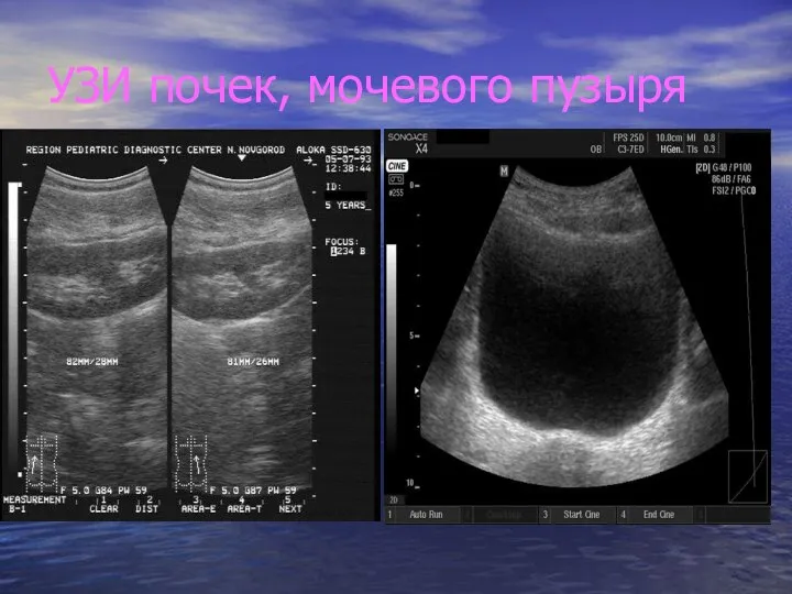 УЗИ почек, мочевого пузыря