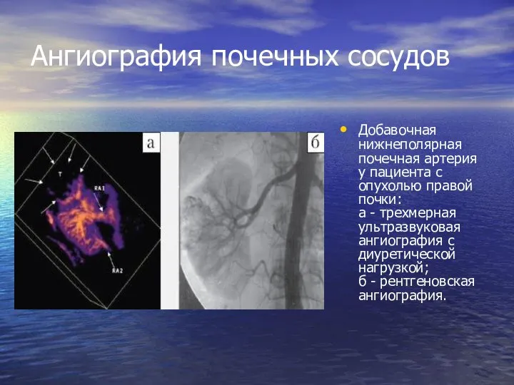 Ангиография почечных сосудов Добавочная нижнеполярная почечная артерия у пациента с опухолью