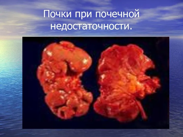 Почки при почечной недостаточности.