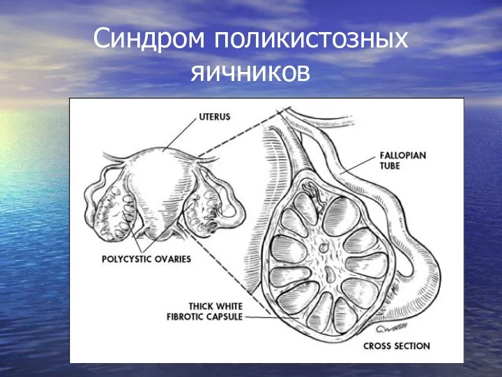 Синдром поликистозных яичников